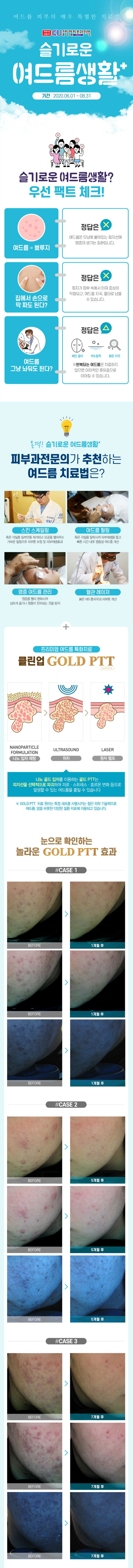01_클린업_6-8월이벤트(여드름)_m(공지용1_1).jpg